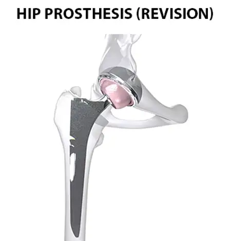 Hip prosthesis revision