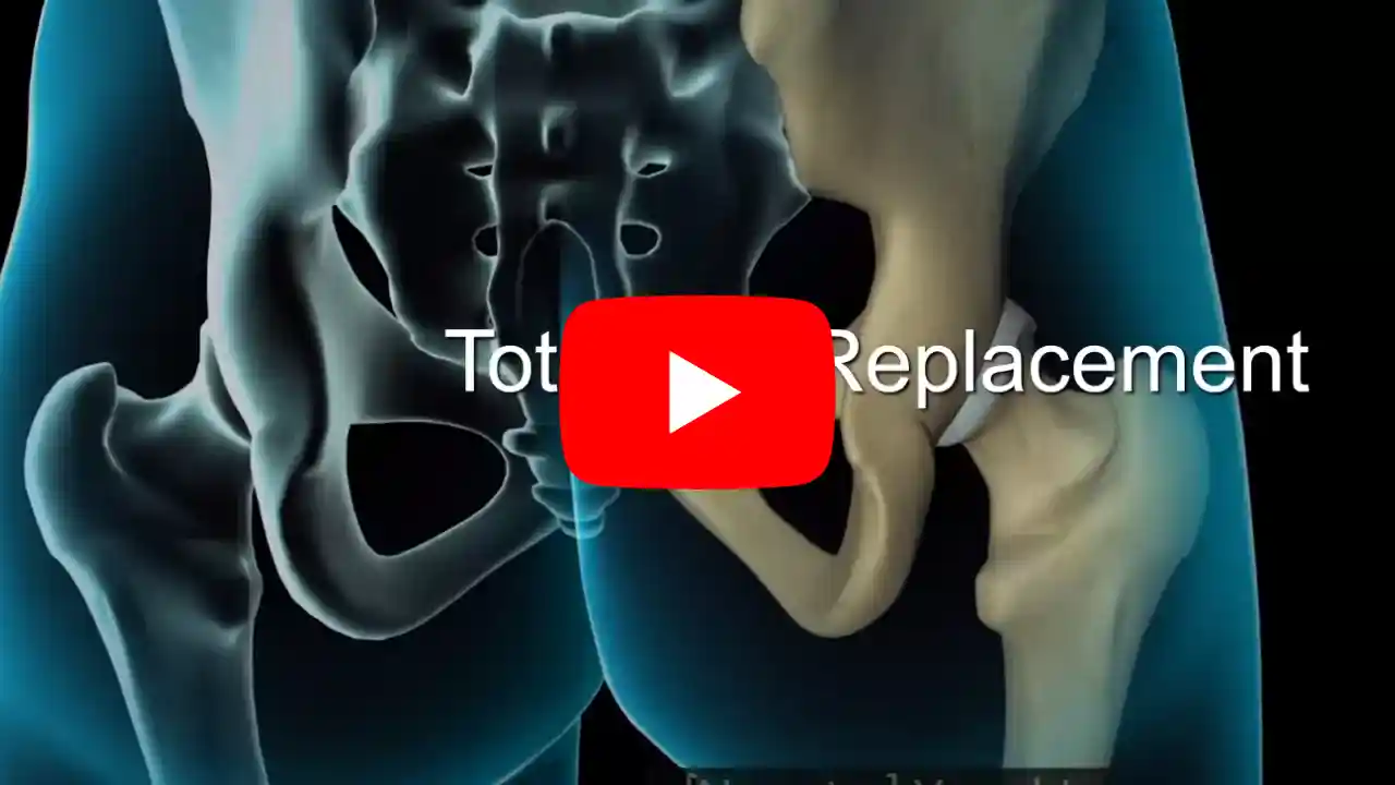 Total Knee Replacement Surgery Both knees