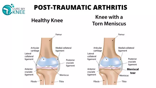 Best Doctor for Knee Replacement Surgery in South Delhi