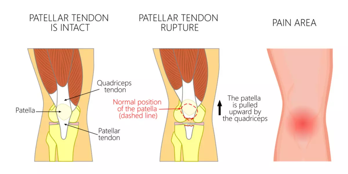 Best Exercises For Fractured Patella