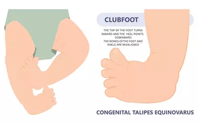 Clubfoot Deformities Treatment in Delhi