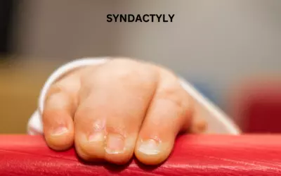 Syndactyly Treatment in Delhi