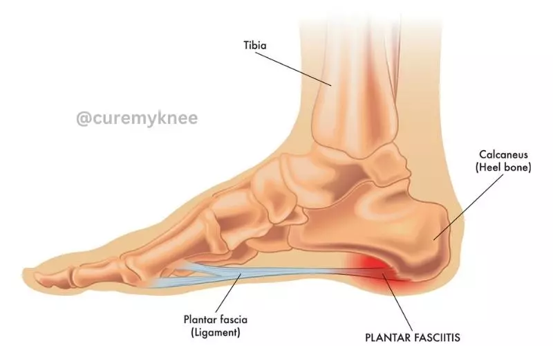 Why Does My Heel Hurt When I Walk? - Cure My Knee