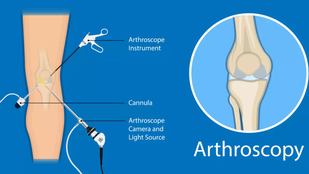 आर्थोस्कोपी सर्जरी क्या है? - Arthroscopy Meaning in Hindi 