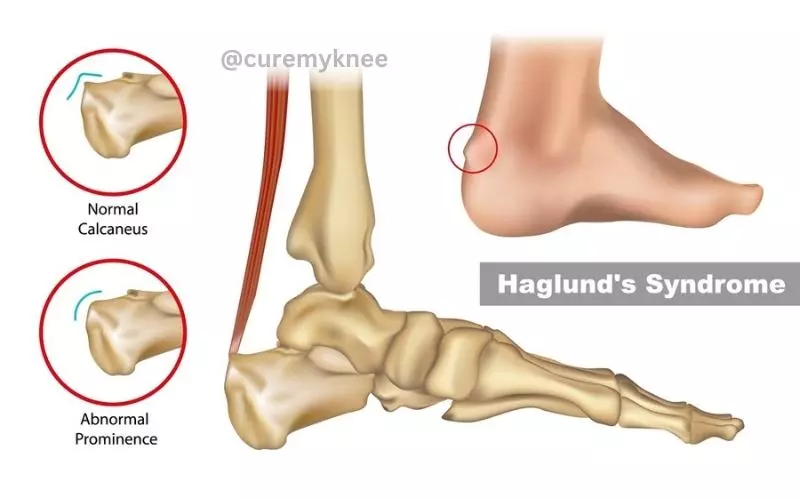Haglund's Deformity image Heel Pain reason in Hindi