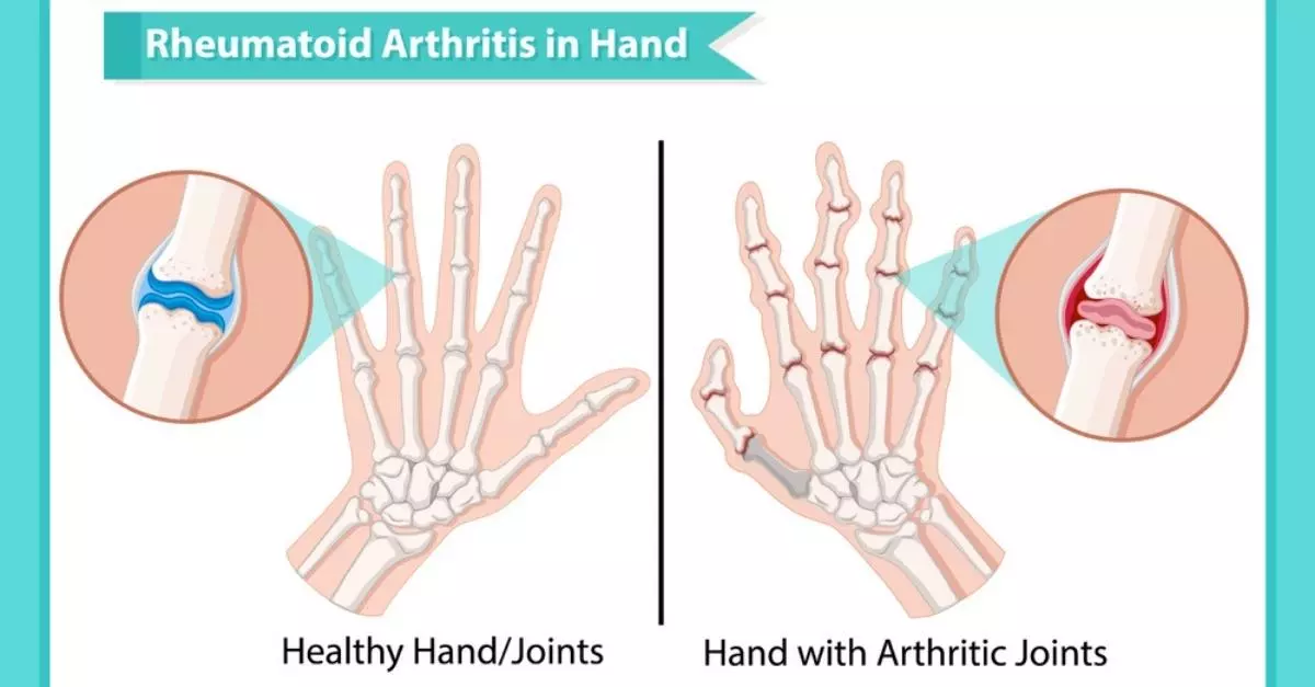 Stages, Causes Symptoms of Rheumatoid Arthritis in Hindi