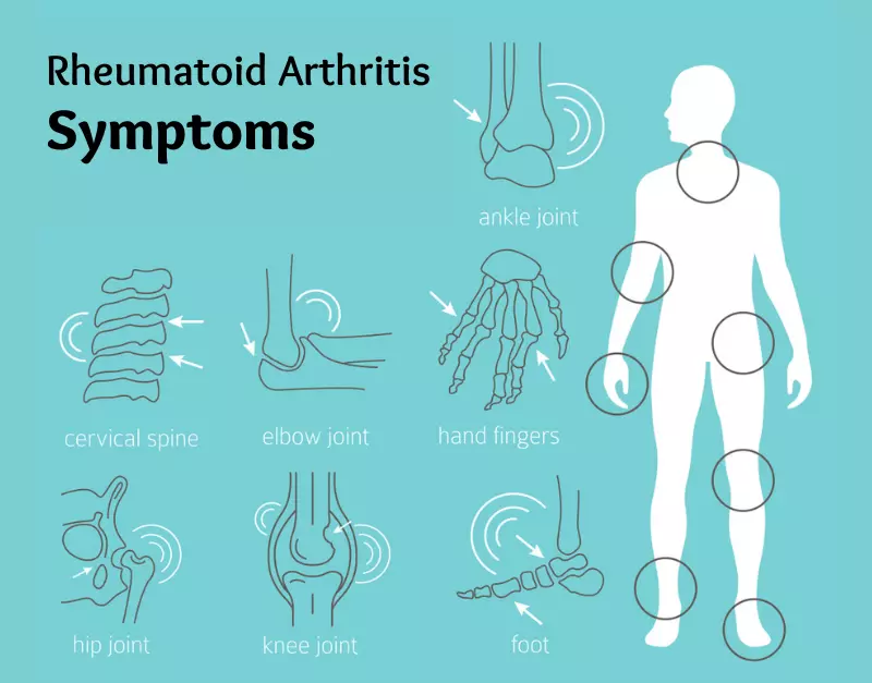 Rheumatoid Arthritis Symptoms in Hindi