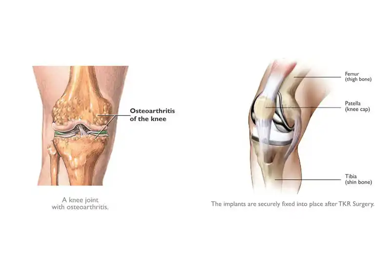 Knee Pain Treatment in Delhi