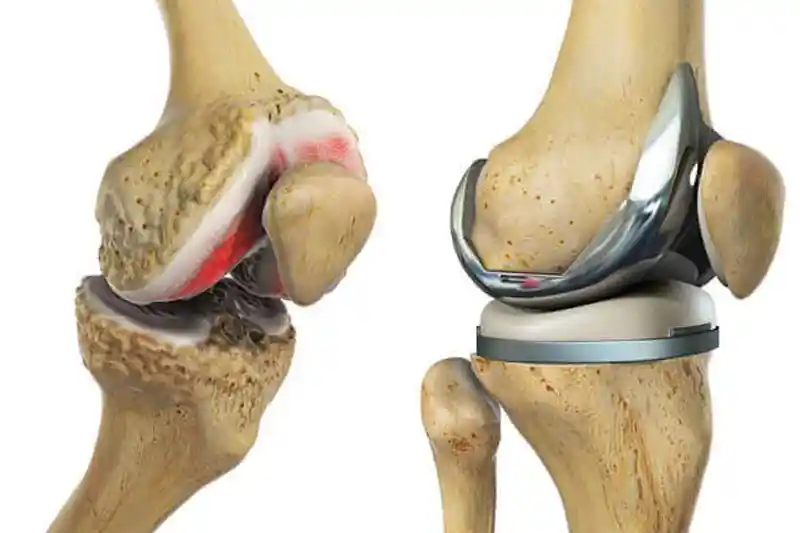 knee replacement surgery cost in india