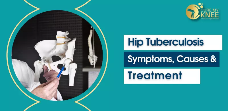 Hip Tuberculosis: TB Symptoms, Causes, Treatment
