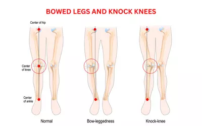 Chlid Bowed Legs and Knock Knees Treatment in Delhi