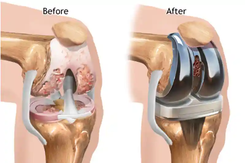 Best Knee Replacement Surgery in Delhi NCR