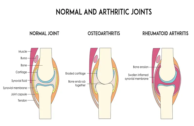 normal and arthritic joints